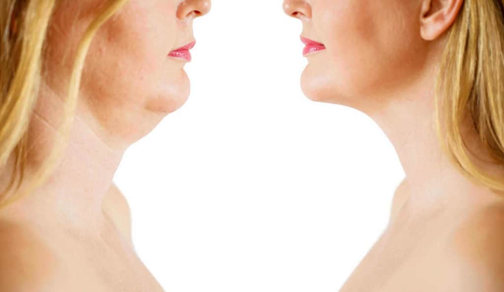 Double Chin treatment Hockley before and after results
