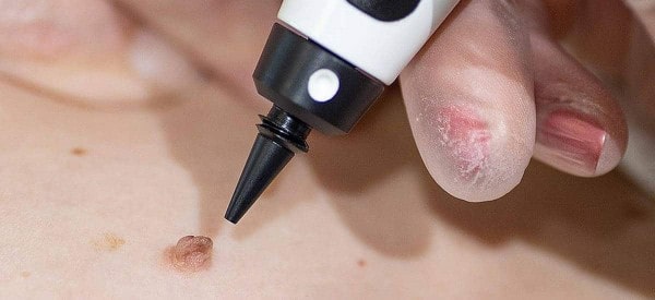 After Skin Tag Removal Hockley