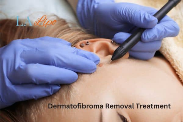 Dermatofibroma Removal Treatment Hockley