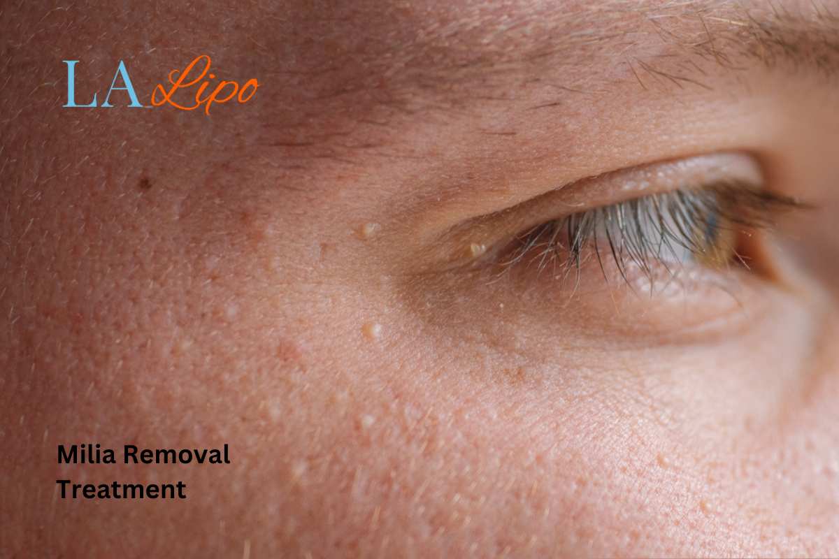 Cryopen Milia Removal: Is It the Easiest and Safest Option Hockley?