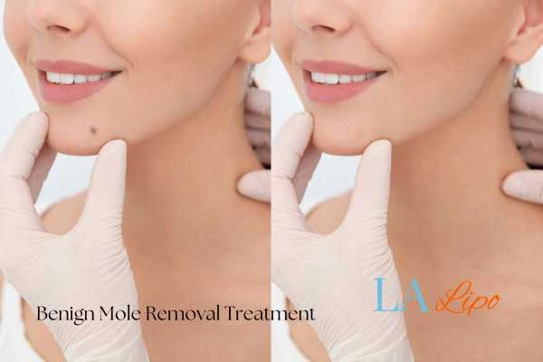 woman's before and after mole removal Hockley results