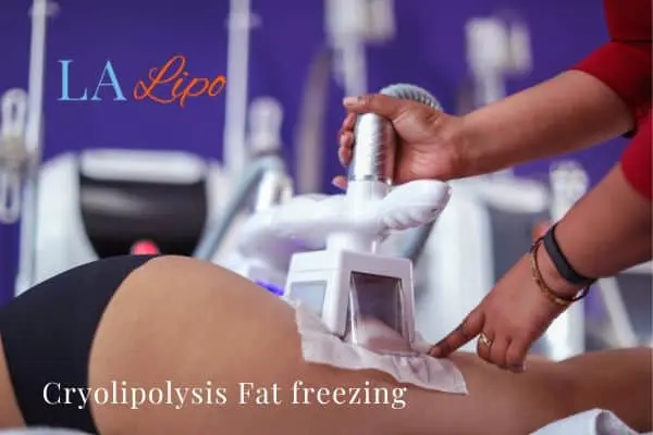 women getting fat freezing Hockley