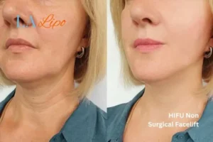 hi-fu for wrinkles Hockley before and after results