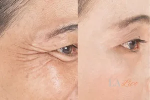 Before and after results of woman - HI-fu wrinkles reduction treatment Hockley
