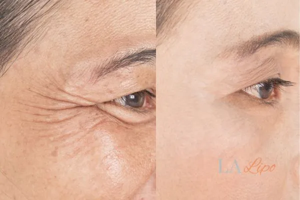 Before and after results of woman - HI-fu wrinkles reduction treatment Hockley