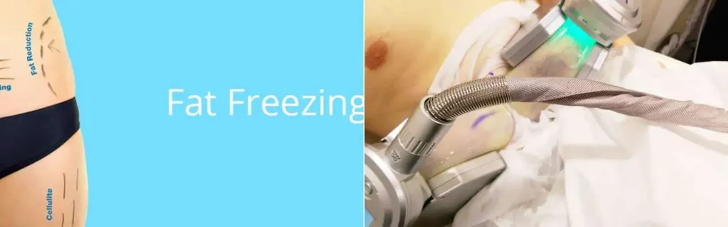 Fat freezing Hockley on multiple areas of the body