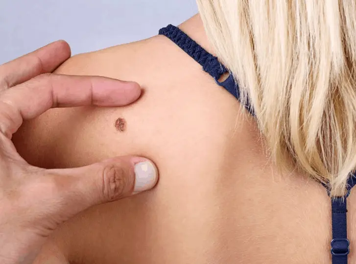 woman having mole removal Hockley consultation before treatment.