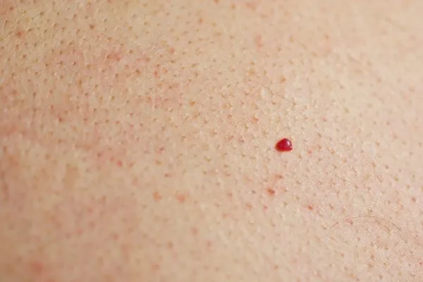 close up of a cherry angioma Hockley