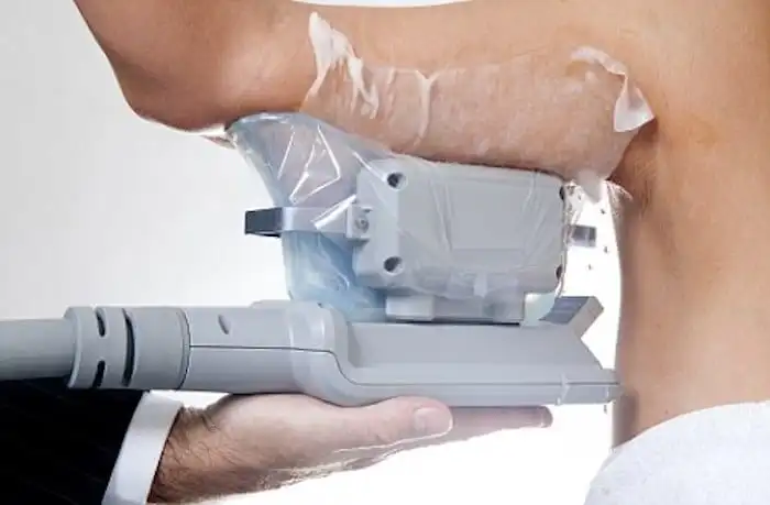 Picture of fat freezing Hockley on the upper arms.