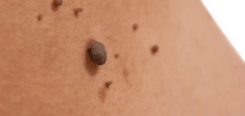 image of a skin tag Hockley