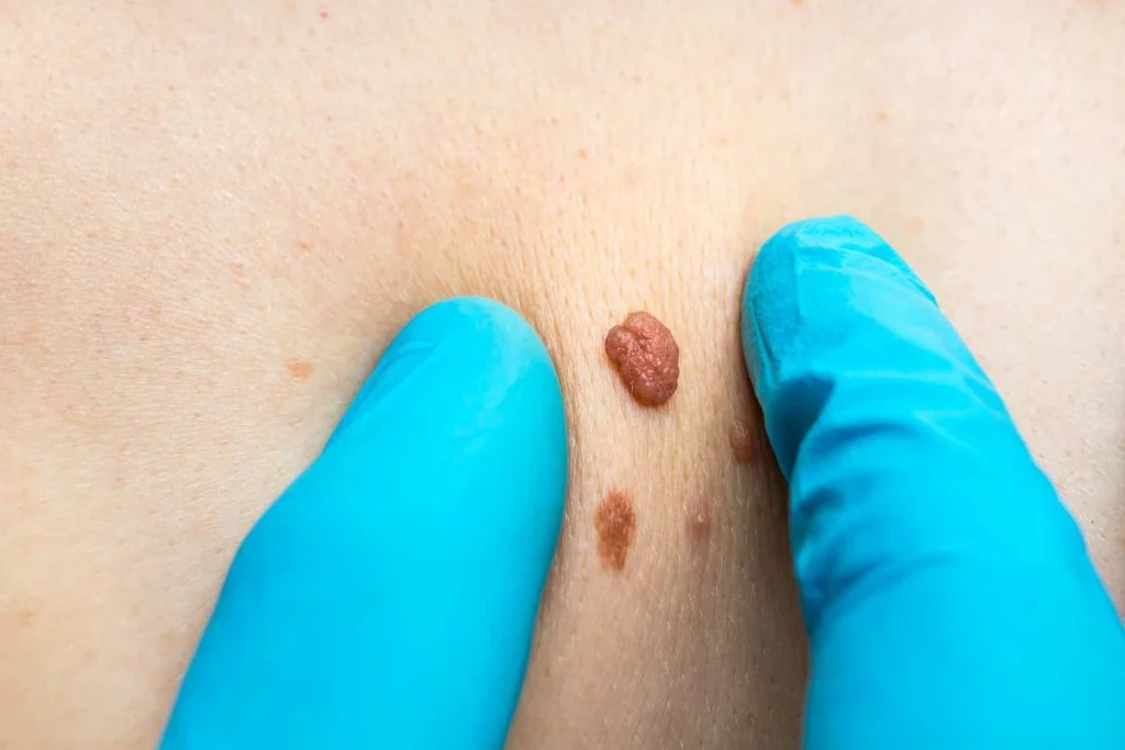 Consultant examining a skin tag Hockley