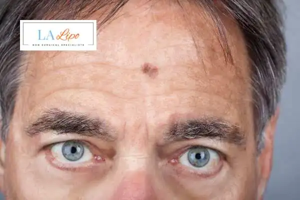 Solar Lentigo Removal Hockley image of man with mark on his forehead