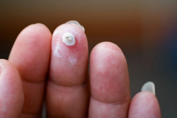 wart on person finger - cryotherapy to treat from LA LIPO Hockley