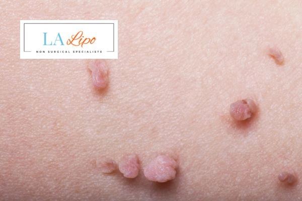 Does cryopen skin tag removal Hockley hurt? Find out now call our team today!