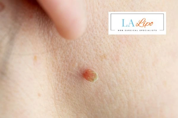 Book skin tag removal Hockley today speak to our team now!