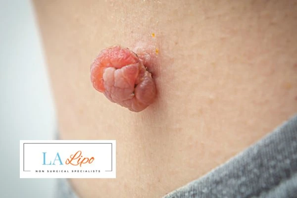 Interested in skin tag removal Hockley? Concerned about the pain? Find out more today!
