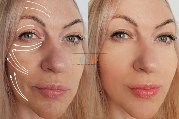 Morpheus 8 results Hockley face lift.