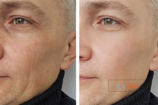See the amazing results of Morpheus8 Treatment Hockley!