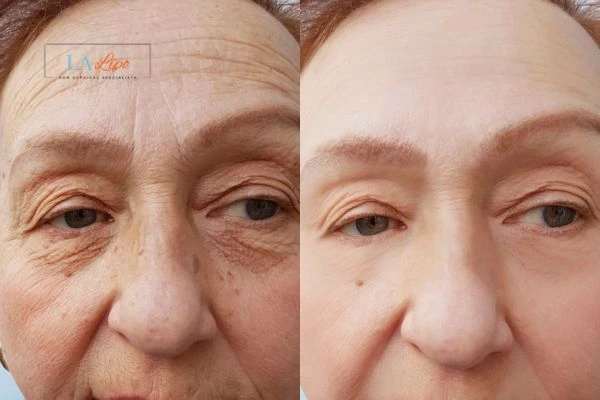 The powerful benefits of Morpheus8 Treatment Hockley - Call Our team today!