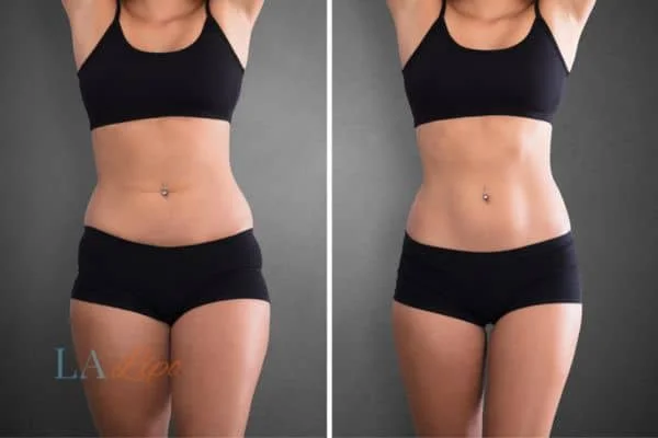 before and after results of non-surgical treatment to help a woman's body image and mental health Hockley
