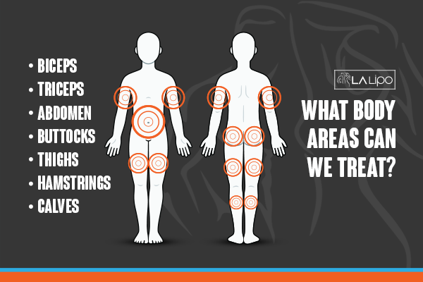 Diagram to show areas you can have LA-EMS Body Sculpting Treatment Hockley