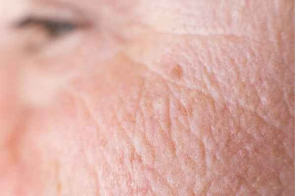 close up picture of a woman's face showing an age spot Hockley