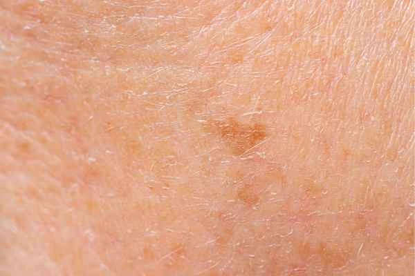 close up picture of age spots Hockley