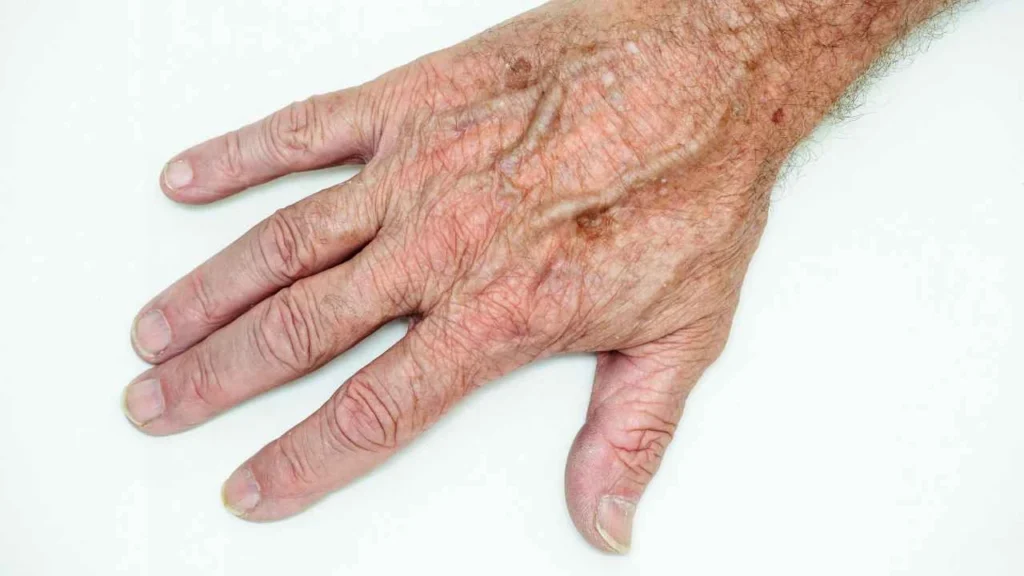 Male hand showing age spot Hockley