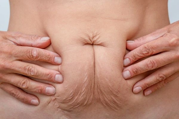 Should I Combine Diastasis Recti Treatment with Body Contouring for Better Results Hockley?