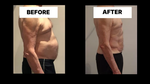 What Symptoms Can Diastasis Recti Cause in Men? Weak Core, Back Pain and Poor Posture Hockley